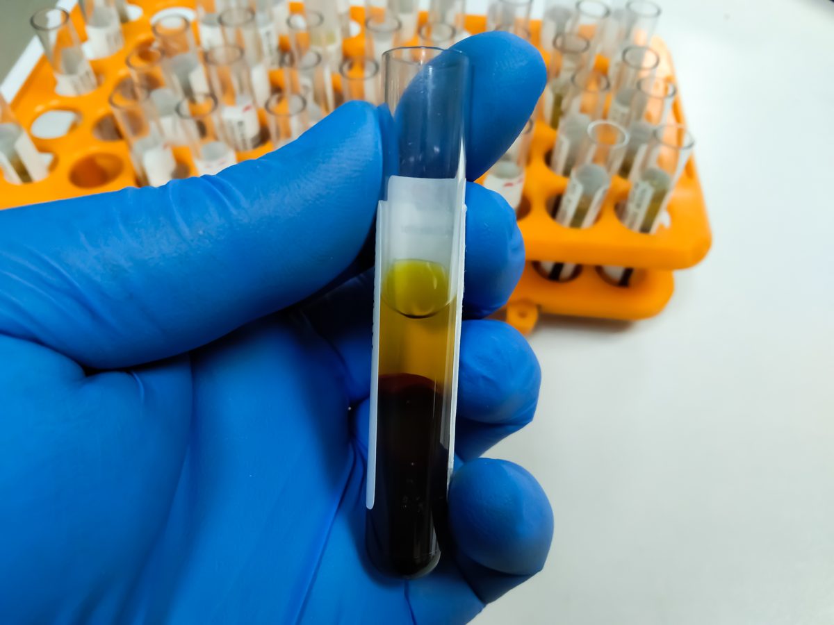 Tubo com concentrado de medula óssea em procedimento de medicina regenerativa